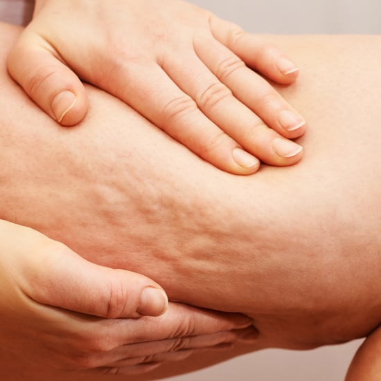 Person's Leg with Cellulite